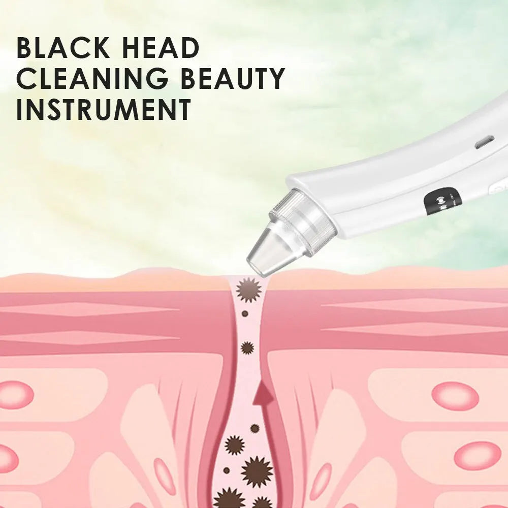 Blackhead Removal
