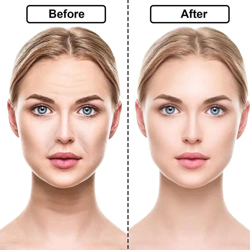 Wrinkle Removal